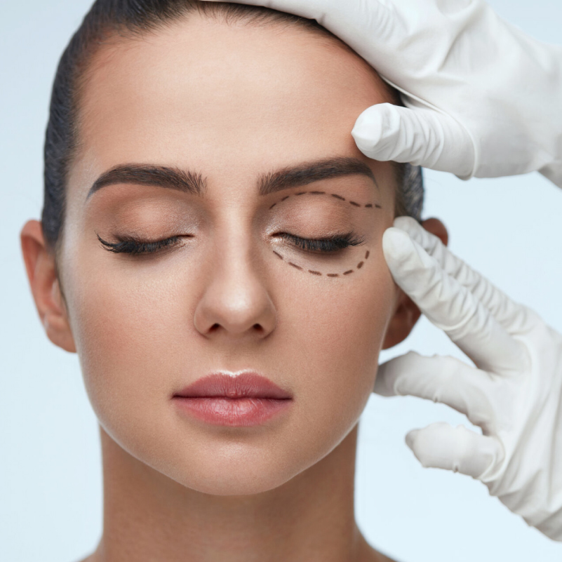 5 blefaroplastia sin cirugÍa