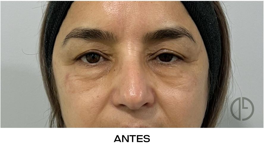 corvalen blefaroplastia 12