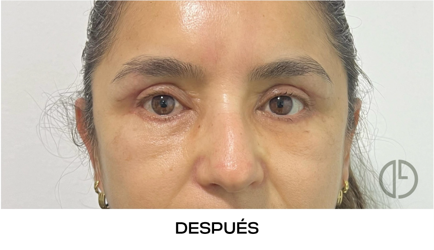 corvalen blefaroplastia 13