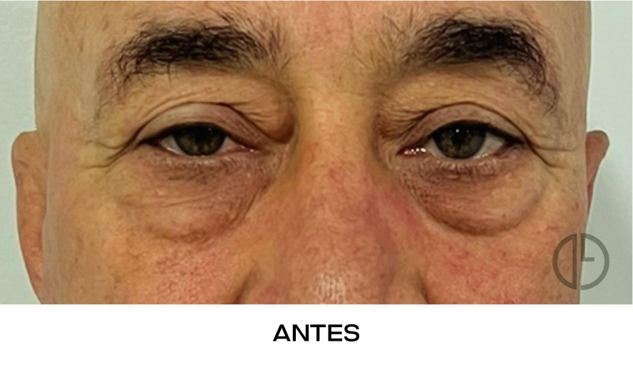 corvalen blefaroplastia 14