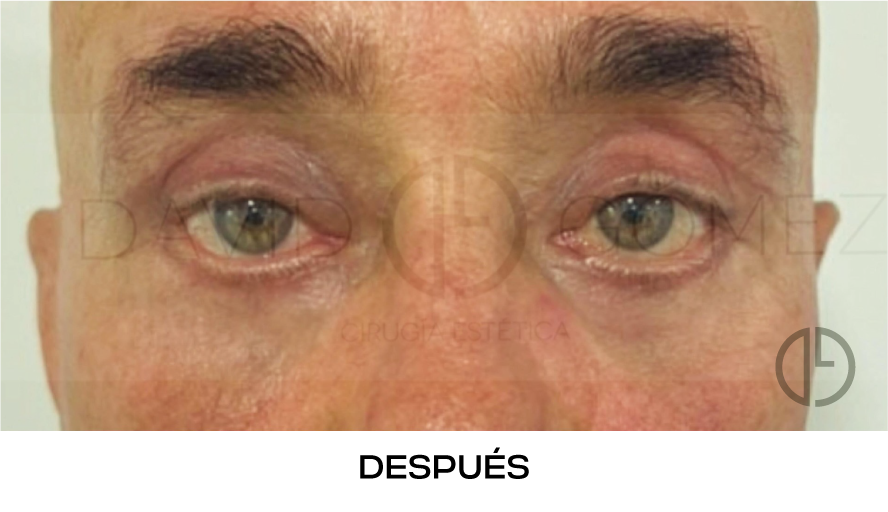corvalen blefaroplastia 15