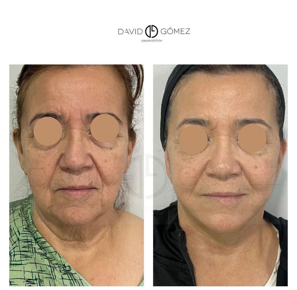 facelift 2