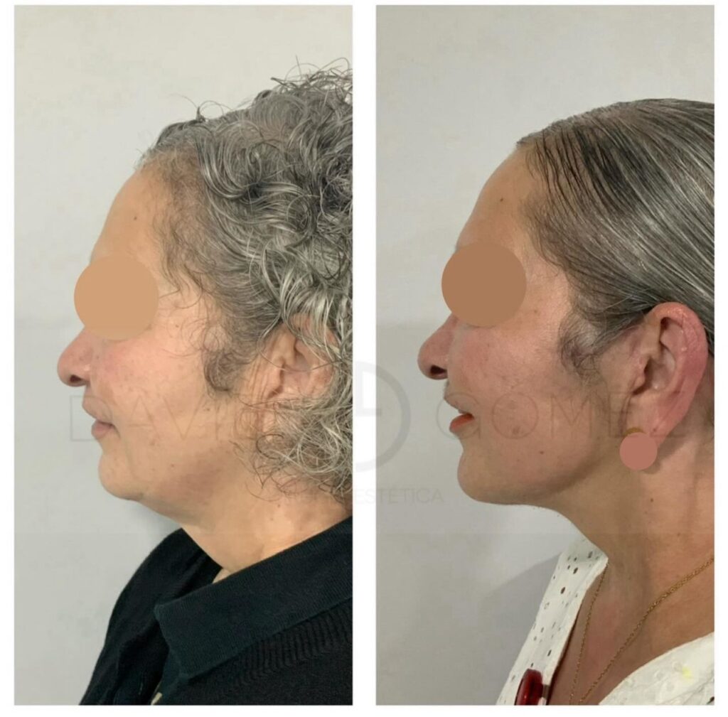 facelift cirugía plástica