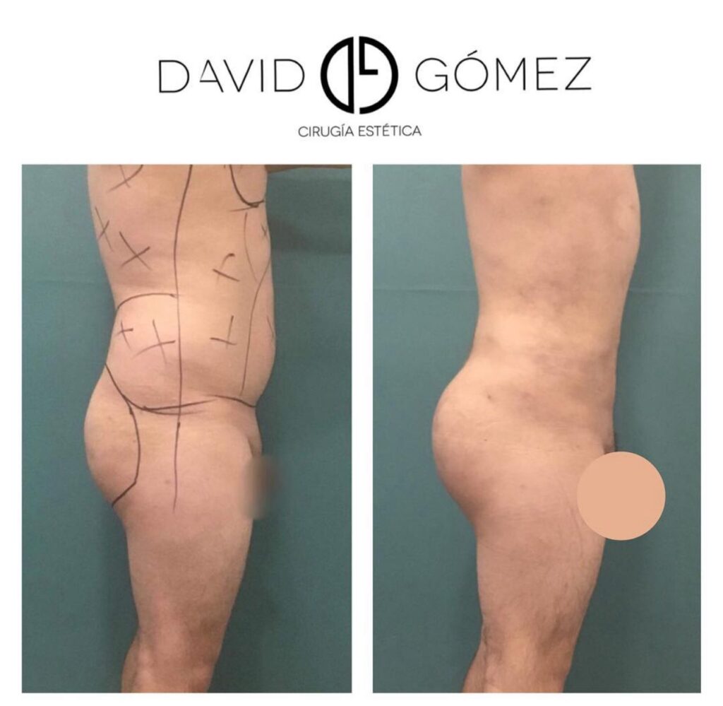 lipo cirugía