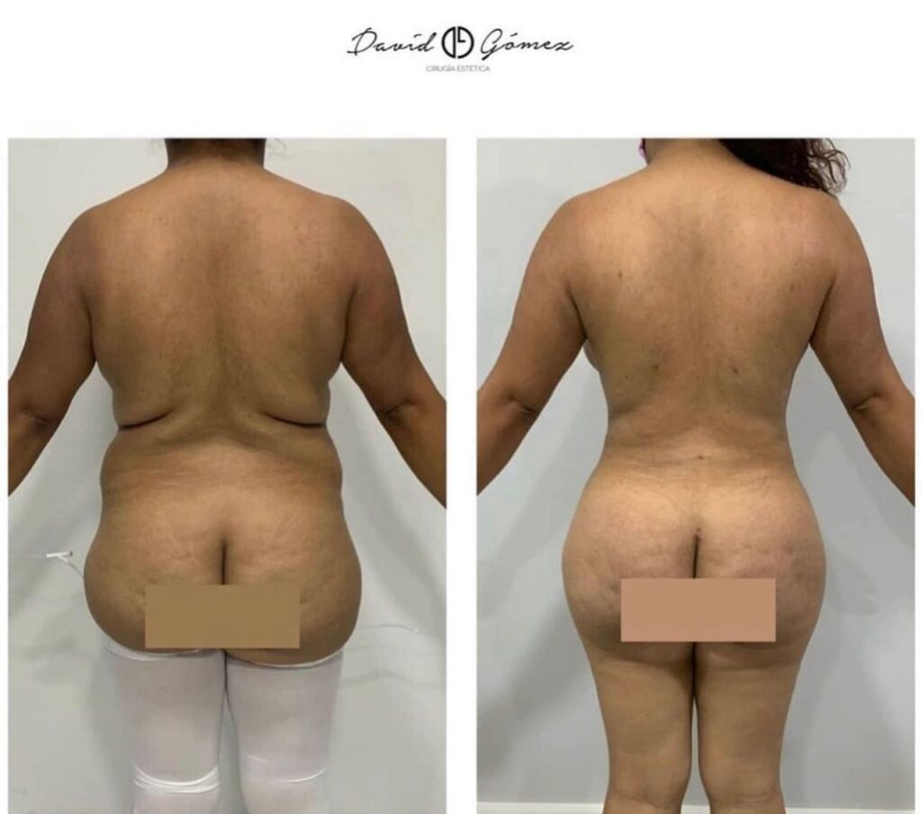 lipo corvalen sugery