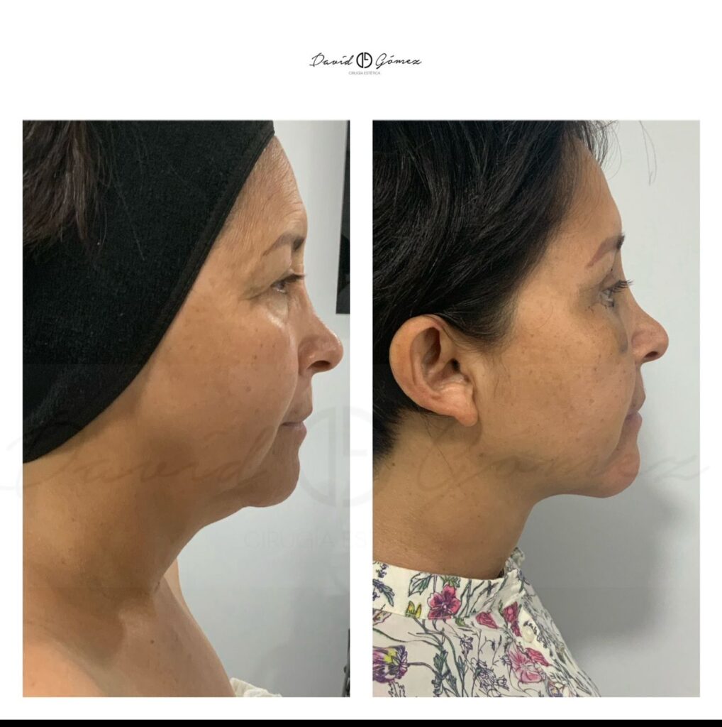 liposucciÓn de papada corvalen sugery
