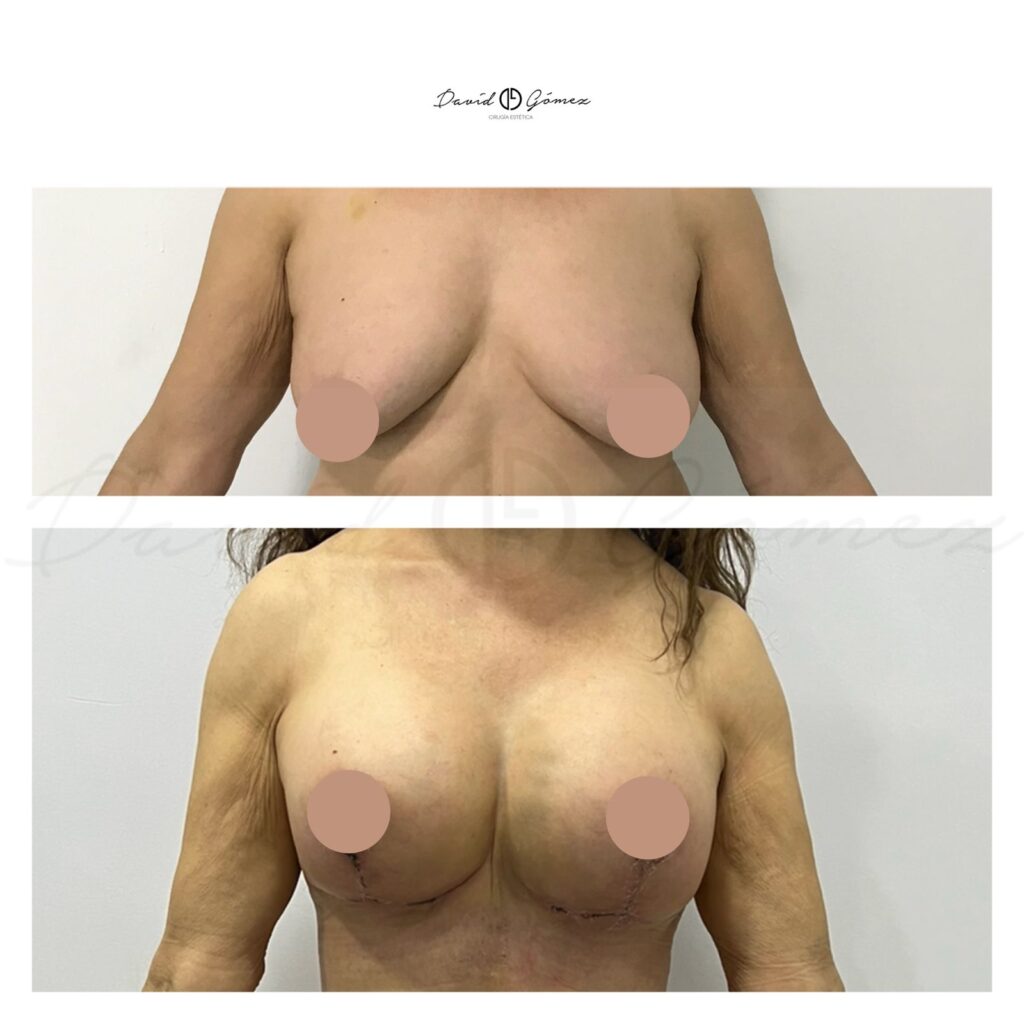 mastopexia cirugía estética