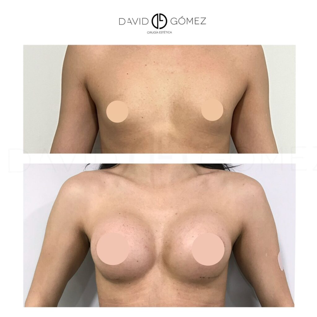 mamoplastia de aumento corvalen sugery